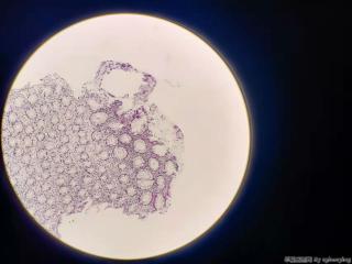 乙状结肠增生性息肉？图2