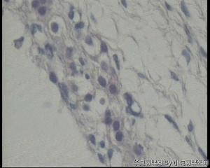 急！发报告，53岁卵巢囊肿，黄素化滤泡囊肿吗？图8