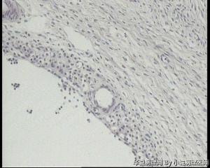 急！发报告，53岁卵巢囊肿，黄素化滤泡囊肿吗？图5