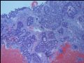 GYN Case 1 from USCAP 2007图2