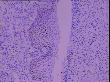65岁，宫颈基底细胞增生？CIN？IHC出来了图3