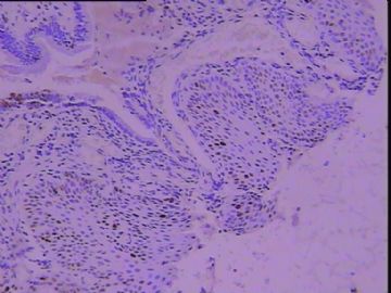 65岁，宫颈基底细胞增生？CIN？IHC出来了图5