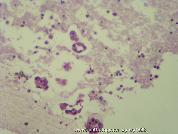 急!心包积液够癌吗?重新上传+细胞学切片图26