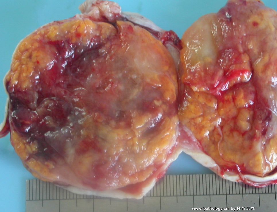 卵巢良性肿瘤图片