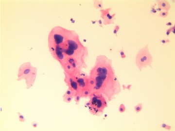 27岁，宫颈液基，H-E染色。图1