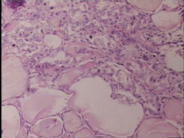 甲状腺肿瘤图12