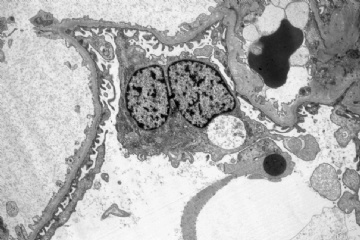 Native kidney biopsy图3