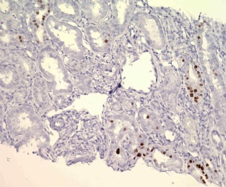 Tranplant Kidney Biopsy图5