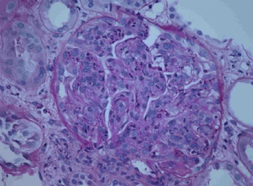 Acute renal failure after endocarditis.图2