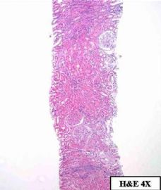 36-year-old woman with persistent microalbuminuria图1