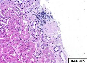 36-year-old woman with persistent microalbuminuria图2