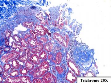 36-year-old woman with persistent microalbuminuria图3