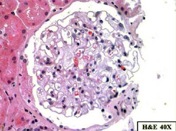 36-year-old woman with persistent microalbuminuria图4