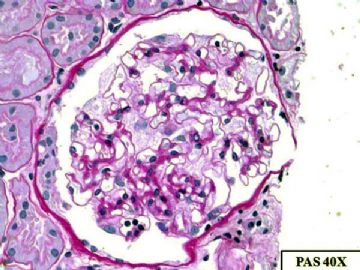 36-year-old woman with persistent microalbuminuria图5