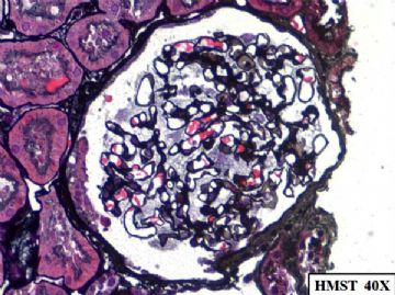 36-year-old woman with persistent microalbuminuria图6