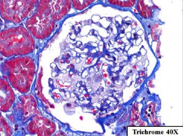 36-year-old woman with persistent microalbuminuria图7