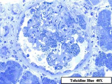 36-year-old woman with persistent microalbuminuria图9