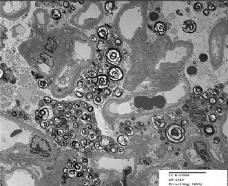 36-year-old woman with persistent microalbuminuria图10