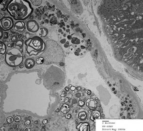 36-year-old woman with persistent microalbuminuria图11