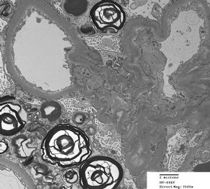 36-year-old woman with persistent microalbuminuria图12