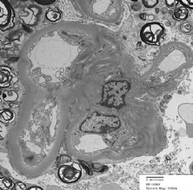 36-year-old woman with persistent microalbuminuria图13