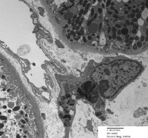 36-year-old woman with persistent microalbuminuria图14