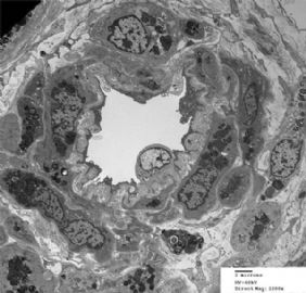 36-year-old woman with persistent microalbuminuria图15