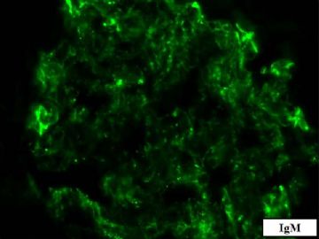 36-year-old woman with persistent microalbuminuria图16