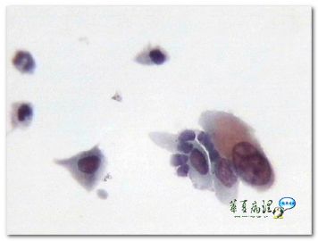 宫颈液基．３４岁．肥大糜烂图3