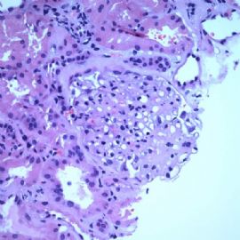 61 years old man with proteinuria.图1