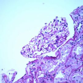 61 years old man with proteinuria.图2