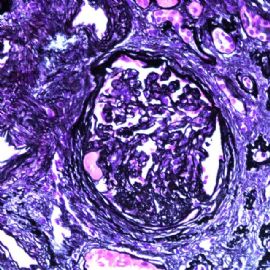 61 years old man with proteinuria.图5