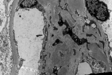 61 years old man with proteinuria.图10