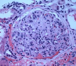 Adult with proteinuria.图2