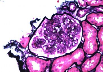 Adult with proteinuria.图5