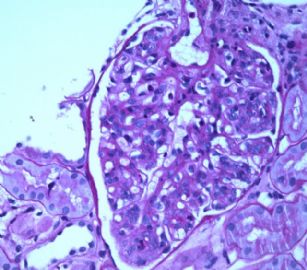 Adult with proteinuria.图7