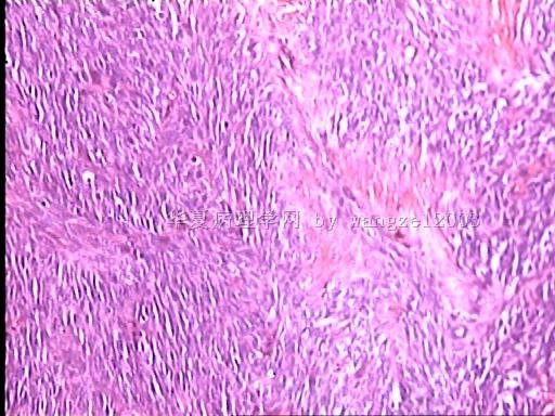 请教这个大腿肿物的诊断。图5