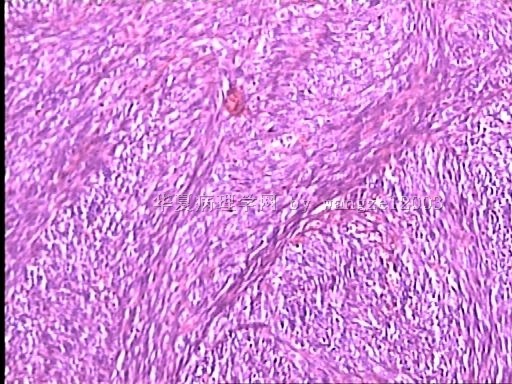 请教这个大腿肿物的诊断。图6