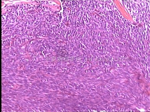 请教这个大腿肿物的诊断。图8