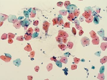 宫颈液基细胞学-地坛15图1