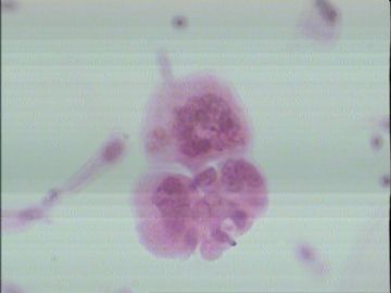 LCT101121患者，25岁，宫颈重糜，请教各位老师这例该如何报为妥？图8