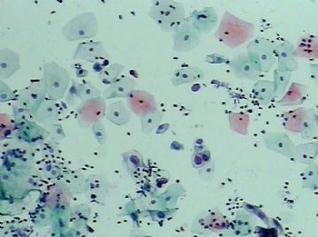 宫颈TCT（19）-组织学图片已上传图1