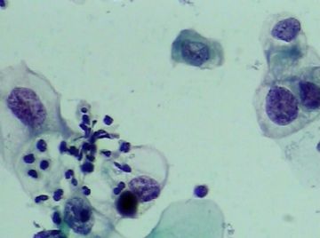 宫颈TCT（19）-组织学图片已上传图2