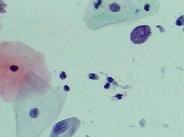 宫颈TCT（19）-组织学图片已上传图3