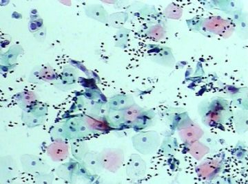 宫颈TCT（19）-组织学图片已上传图4