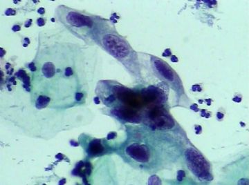 宫颈TCT（19）-组织学图片已上传图5