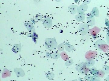 宫颈TCT（19）-组织学图片已上传图6