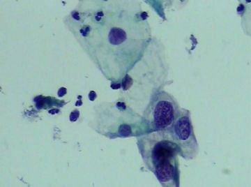 宫颈TCT（19）-组织学图片已上传图7