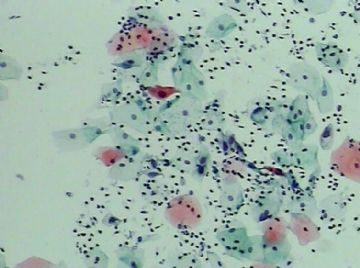 宫颈TCT（19）-组织学图片已上传图8