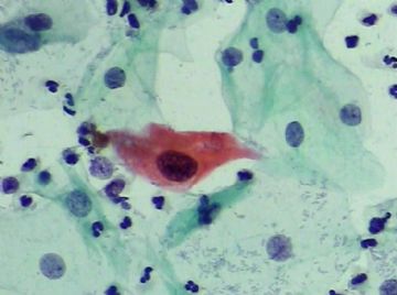 宫颈TCT（19）-组织学图片已上传图9